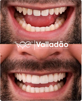 Foto de sorriso tratado na odonto voe, clinica estética especializada em Implantes Dentários