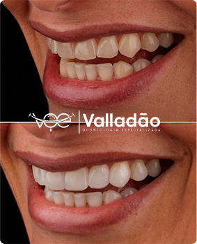 Antes e depois da correção da mordida com ortodontia móvel na Odonto Voe. Dentista em Vespasiano com foco em conforto e resultado.