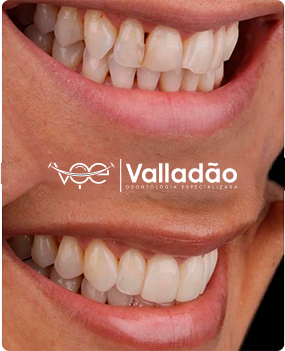 Sorriso renovado após estética bucal em clínica odontológica de Vespasiano. Clareamento e restauração feitos na Odonto Voe.