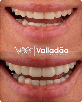 Resultados de tratamento periodontal com gengivoplastia na Odonto Voe em Vespasiano. Dentista especialista em saúde gengival.