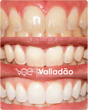 Alinhamento dos dentes com Invisalign em Vespasiano. Antes e depois do tratamento na clínica Odonto Voe, referência em odontologia estética.