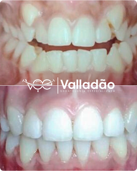 Imagem de antes e depois de tratamento de canal feito na Odonto Voe, clínica odontológica em Vespasiano com atendimento humanizado e tecnologia.