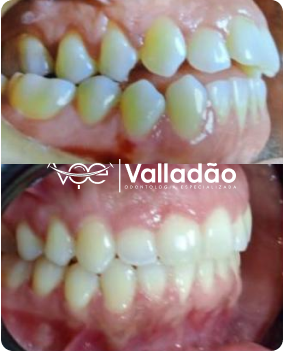 Correção ortodôntica com aparelho fixo realizada por dentista especializado em Vespasiano. Clínica Odonto Voe oferece ortodontia fixa e móvel.