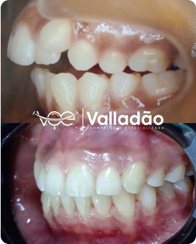 Transformação completa com implantes dentários em Vespasiano. Dentista especialista em reabilitação oral da clínica Odonto Voe.